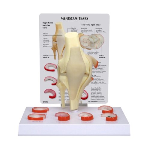 무릎관절 - 반월상연골파열 (G1010)