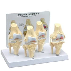 무릎관절 - 퇴행성관절염 4단계 (G110)