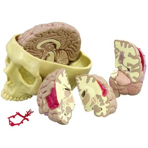 뇌 - 두개골포함, 뇌병변모형 (G290)