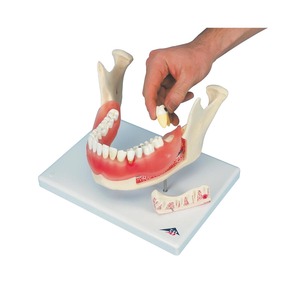 치아 - 치석질환 2배확대 21분리 (D26)
