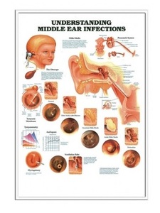 차트(입체) 귀 중이염 (9892)